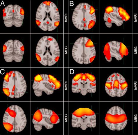 magnetoencephalography images.